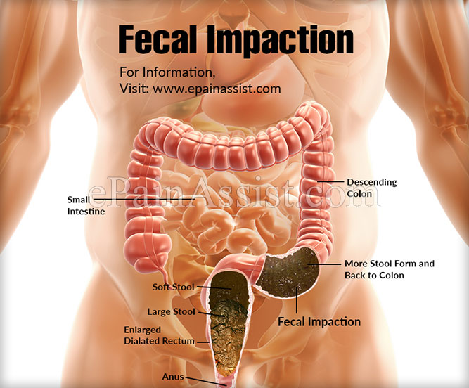 Colonics For Fecal Impaction Colonic Care With Cindy Cerecer