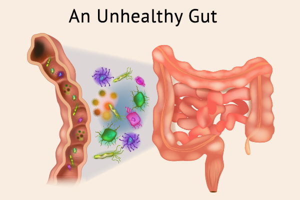 An Unhealthy Gut