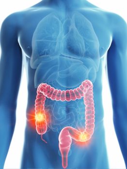 Colonic-Care-Web-Banner(8)-(750-x-1000)_7-May